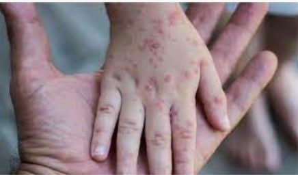 ماهو جدري القردة What is monkeypox